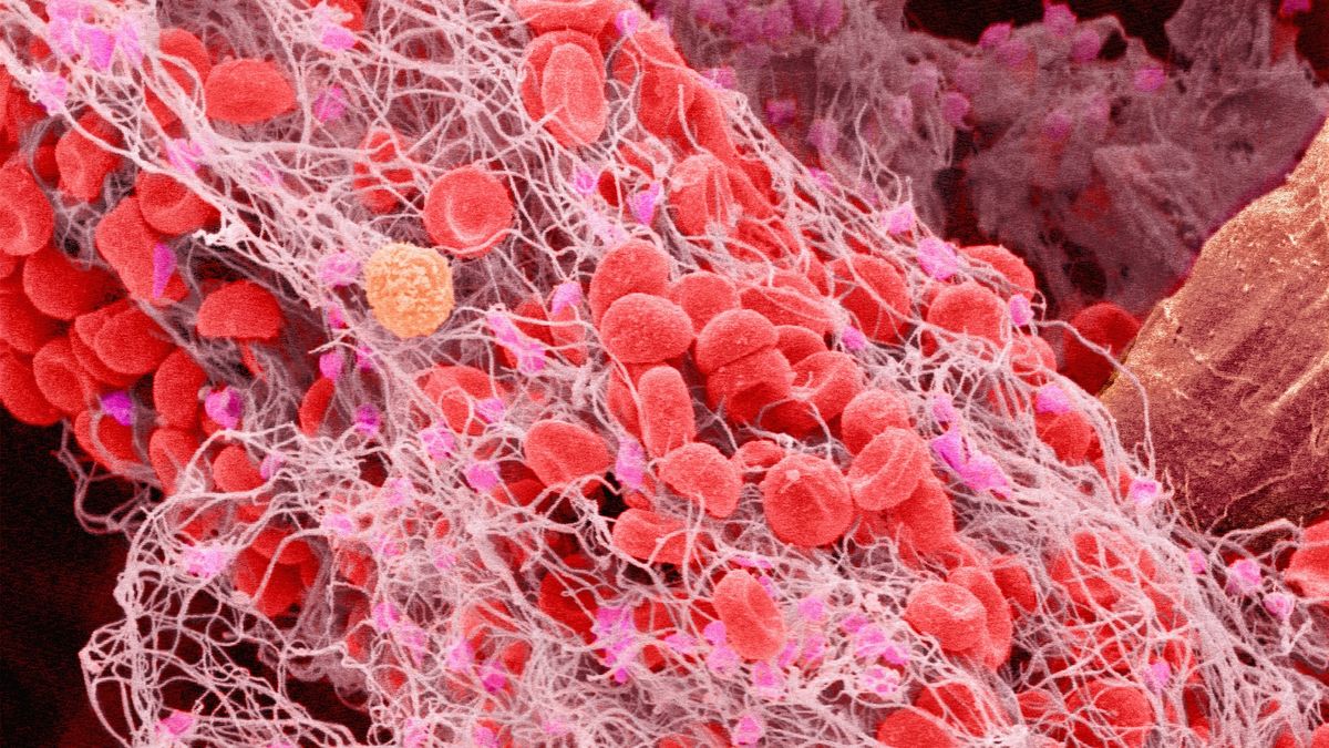 What causes blood clots? | Dwell Science